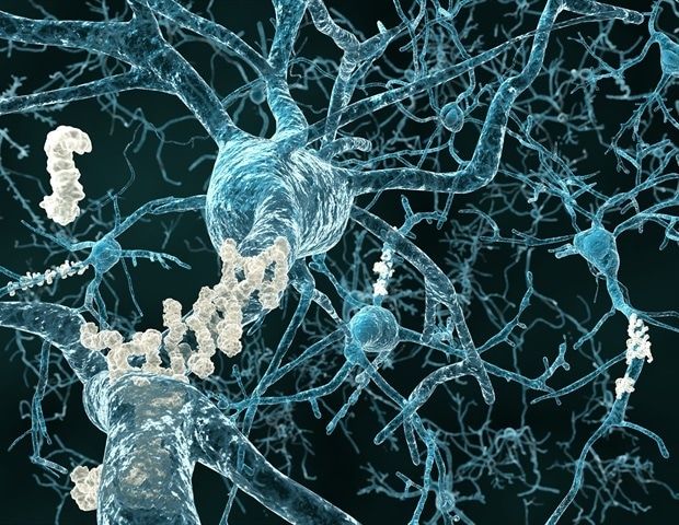 Blood tests improve Alzheimer’s detection in Down syndrome patients - news-medical.net