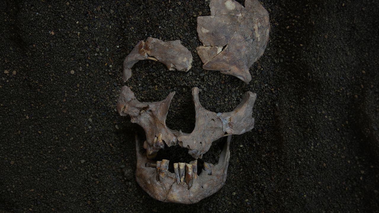 This skull of a prehistoric hunter-gatherer found in Sulawesi, Indonesia, shows extreme dental wear linked by researchers to sucking betel nuts. - Fakhri